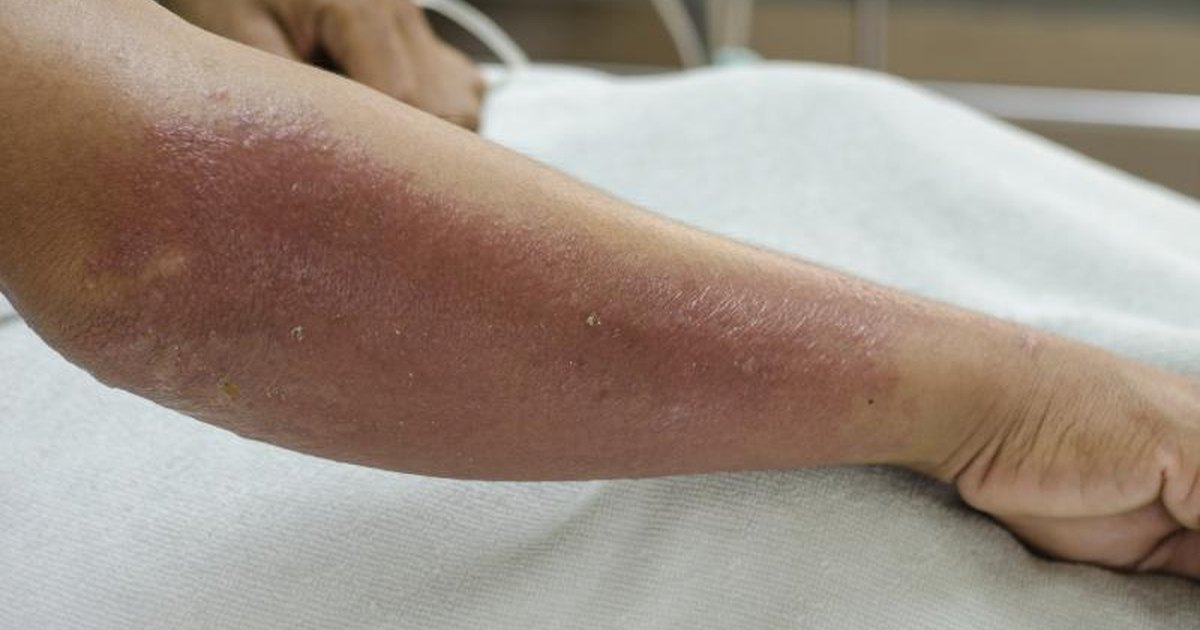 Causes Of A Red Rash On My Arm Livestrongcom