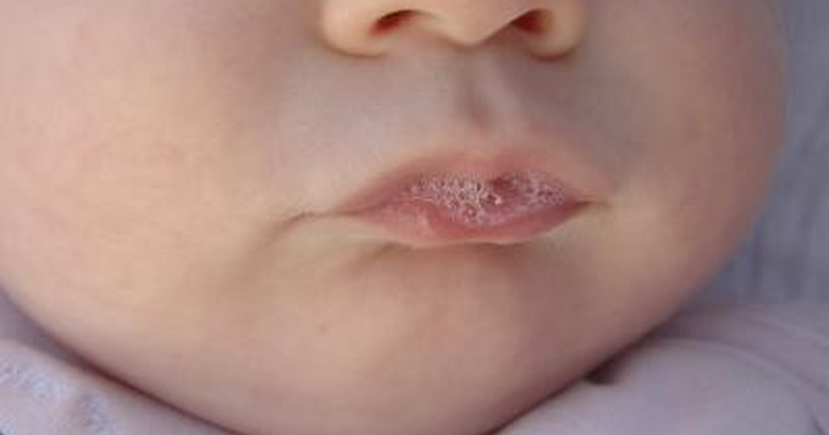 Mouth Sores: Check Your Symptoms and Signs