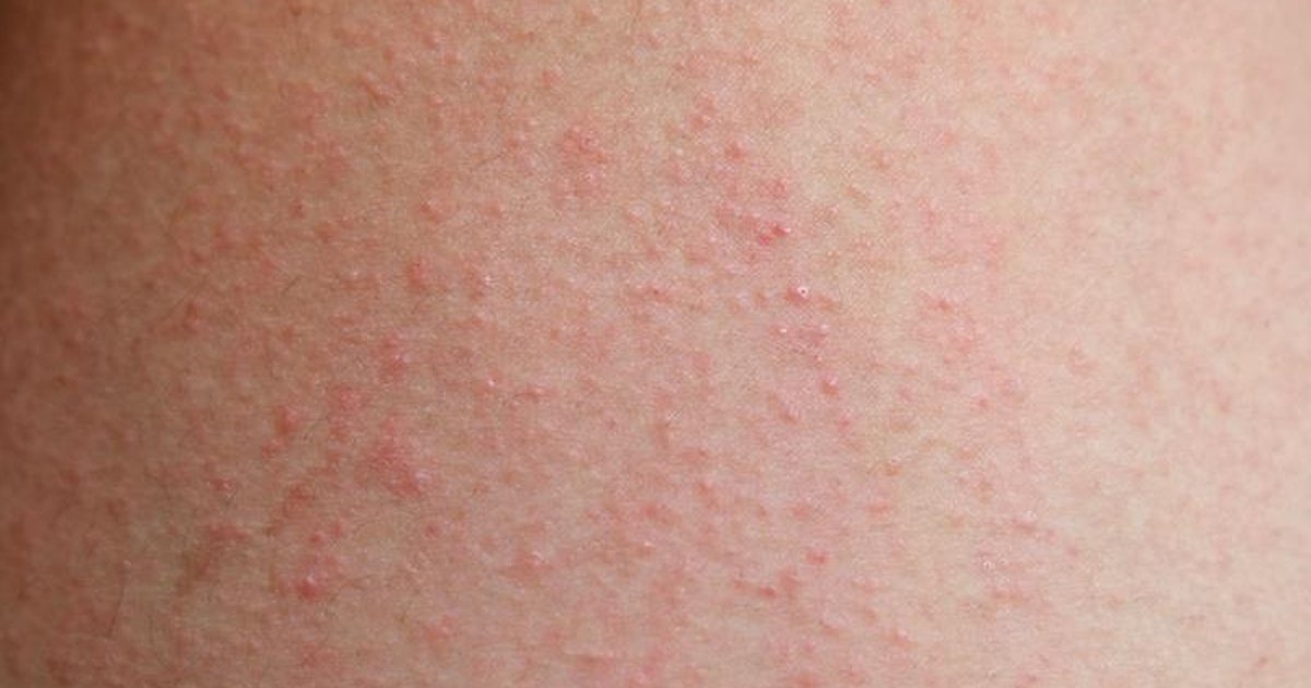 nummular eczema #10