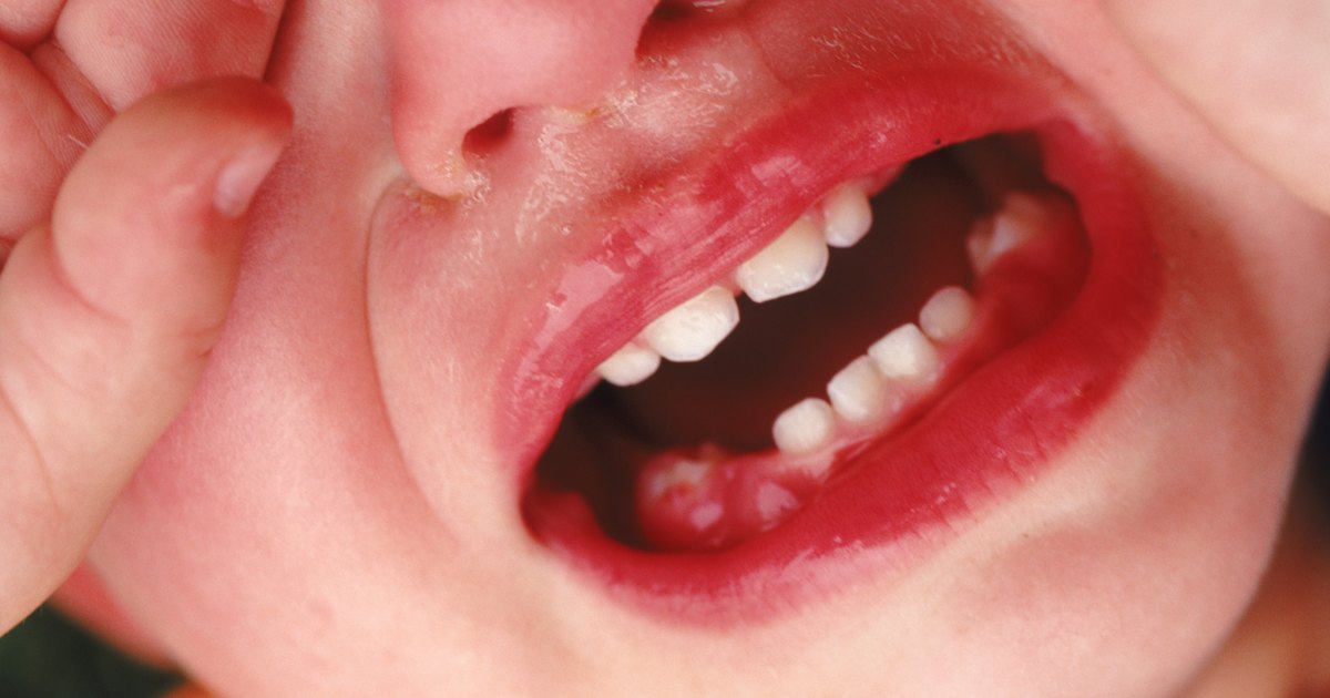 Swollen Gums In An Infant Livestrongcom