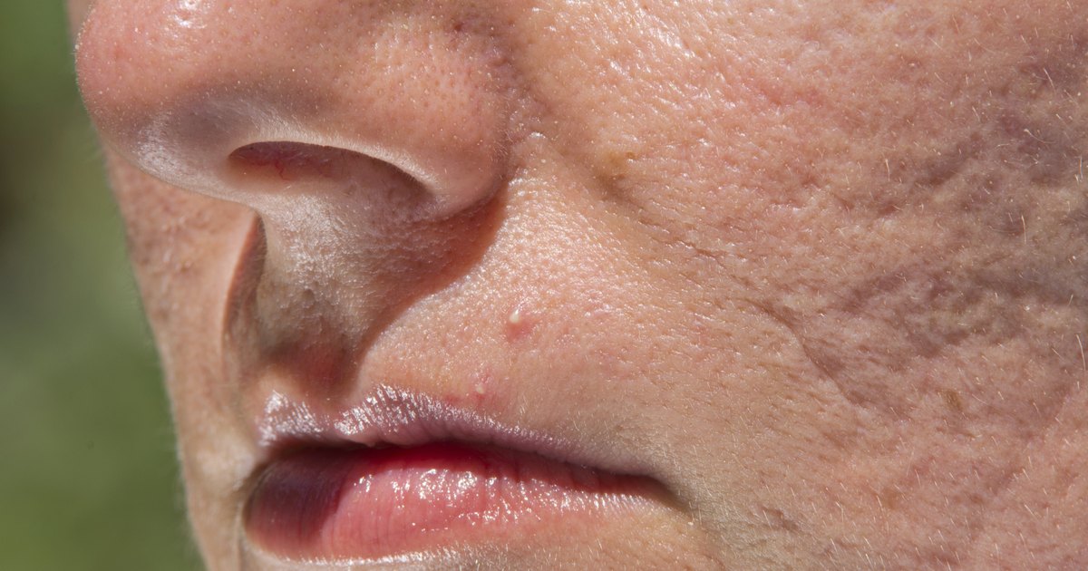 What Are the Dangers of Popping Pimples?