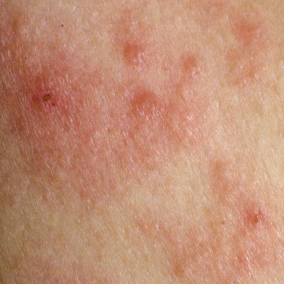 Hardin MD : Skin Rashes : Picture Gallery