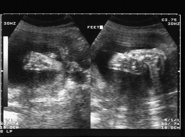 Determining Sex Of Baby Ultrasound 108