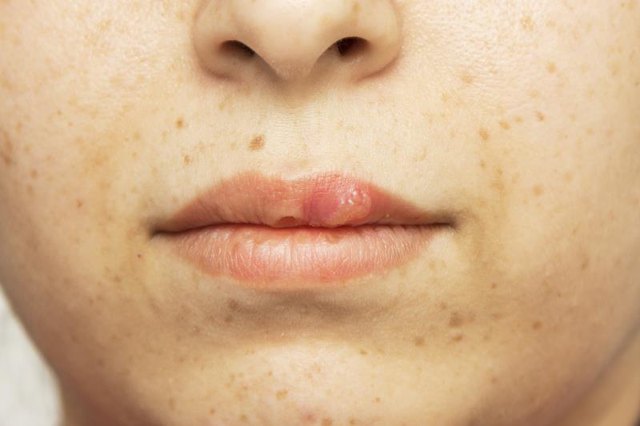 Pimples around Mouth, Lips, Chin, Meaning ... - lightskincure
