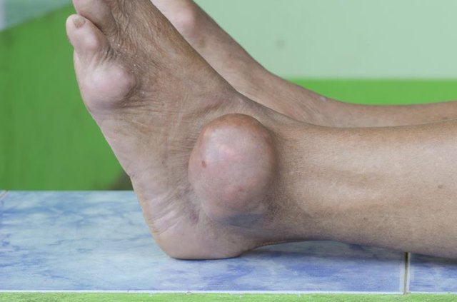 How can you use diet as a remedy for gout in your foot?