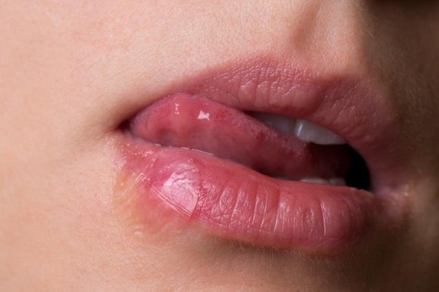 herpes pictures female
