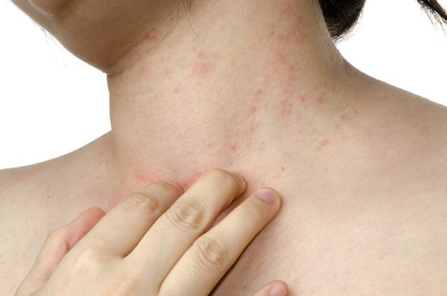 Causes of Itchy Red Bumps on the Neck | LIVESTRONG.COM