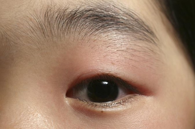 swollen eyelid cold or hot compress