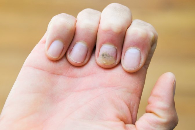How Do I Get Yellow Stains Out of My Nails?