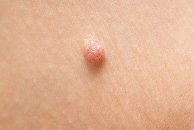 skin tag on skin; home remedies for skin tags