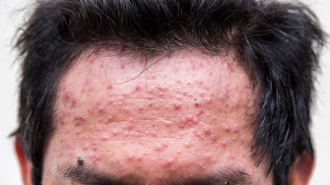 Pictures Of Facial Rashes 108
