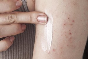 Over the counter eczema cream with steroids