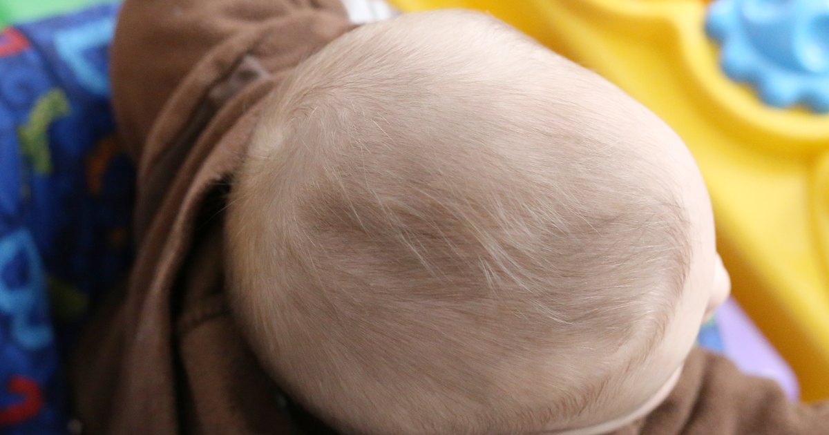 How to Treat Dry Scalp in Babies | LIVESTRONG.COM