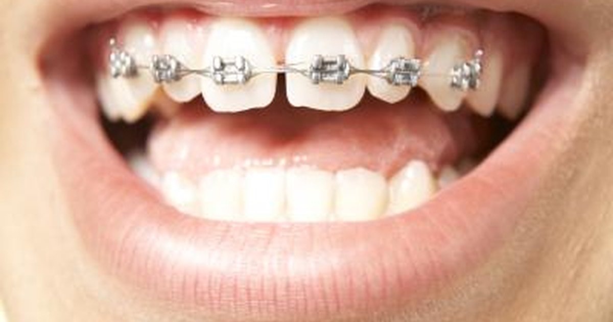About Rubber Bands for Braces