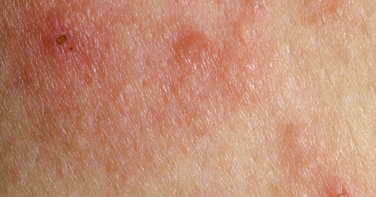skin rashes that itch and are contagious