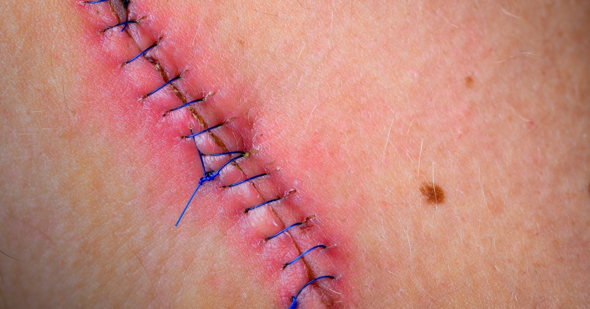 How to Tell If a Suture Scar Is Healing Well | LIVESTRONG.COM