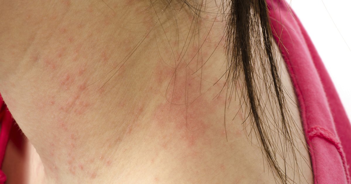 Red Bumps In The Nape Of The Scalp Livestrongcom