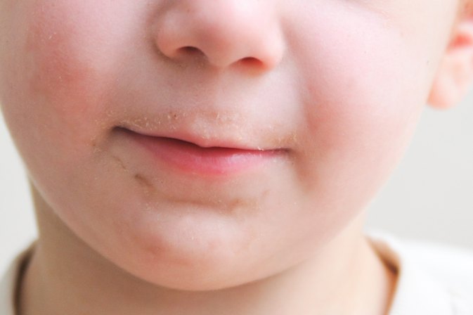 A Toddler's Dry Cracked Lips | LIVESTRONG.COM