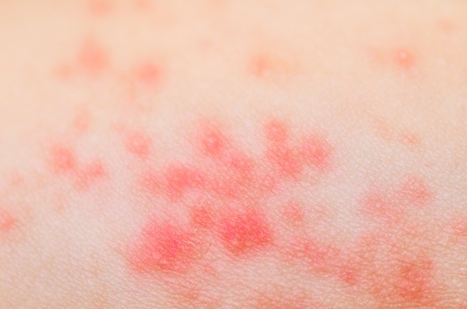 does heat rash itch more at night
