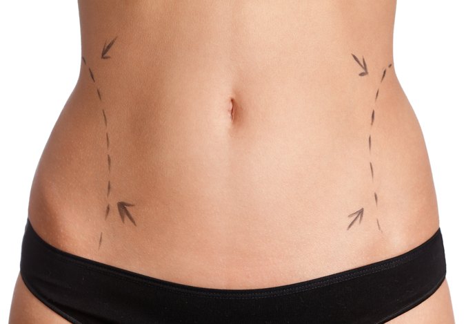 How to Tighten Skin After Liposuction