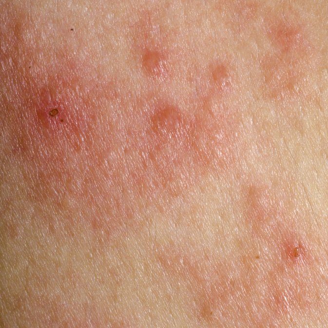itchy skin rash pictures diagnosis