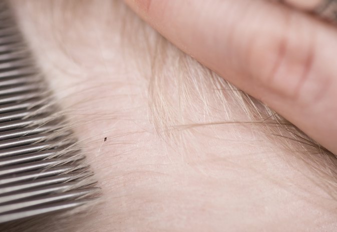 how to get rid of lice eggs in hair