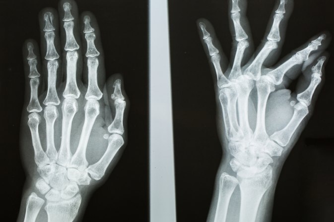 5 Things You Need to Know About Boxer's Fractures