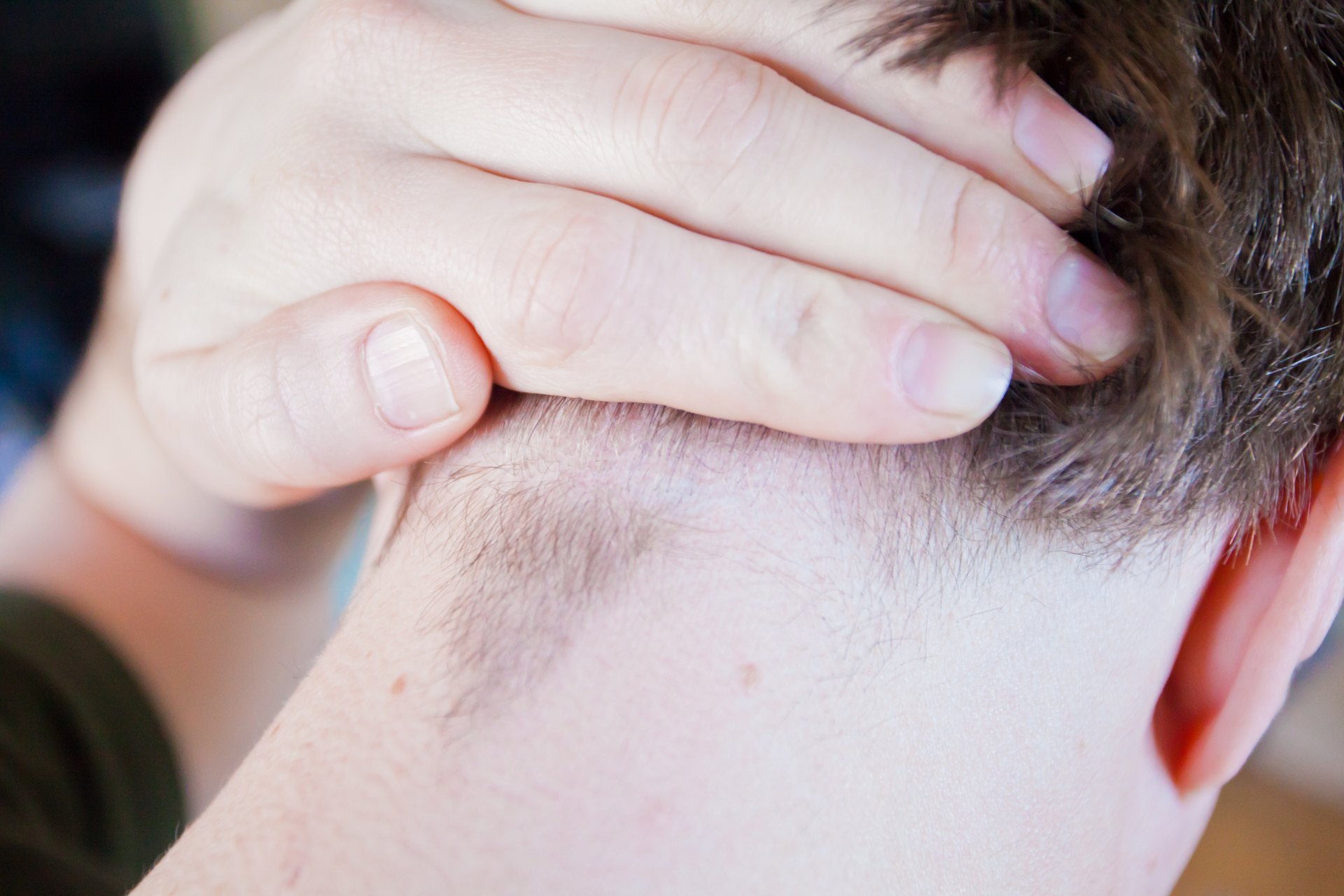 How To Treat Ingrown Hairs On The Scalp LIVESTRONGCOM